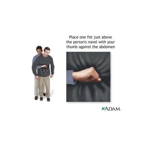 How to do the heimlich maneuver on an unconscious adult